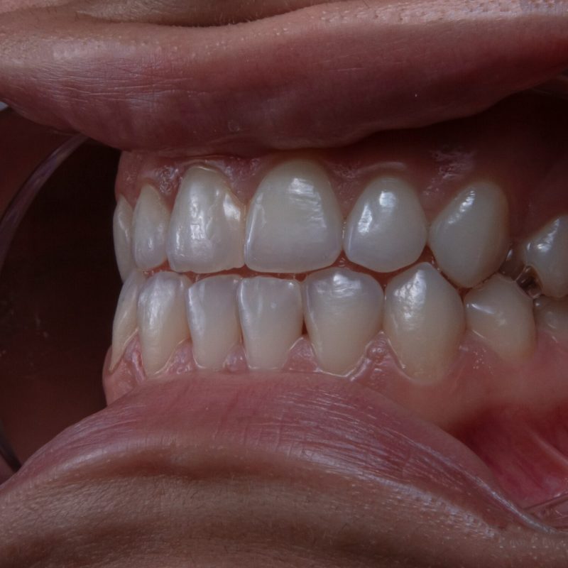 Blanchiment Dentaire Professionnel