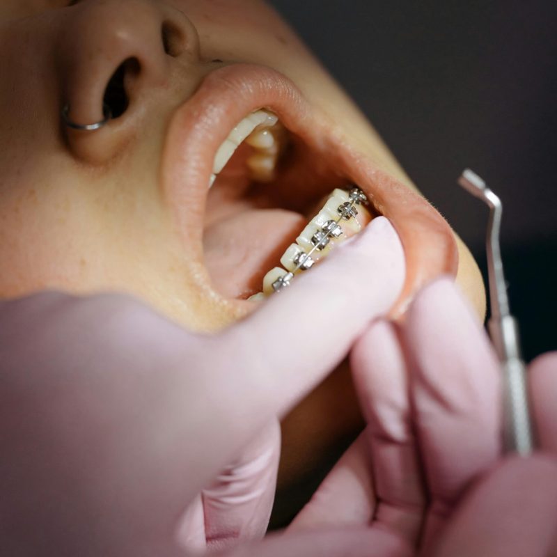 Orthodontie et Alignement